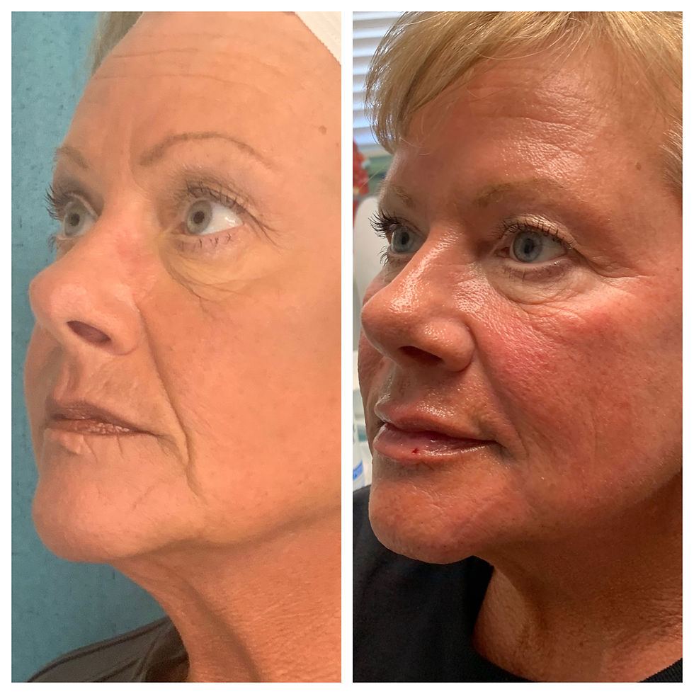 Dermal Filler(4).jpg
