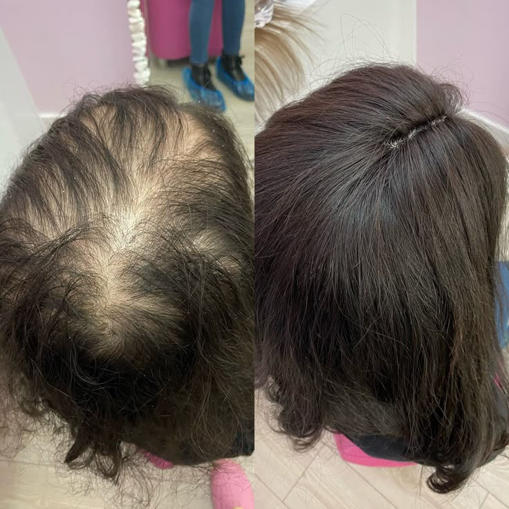 hair transplant turkey