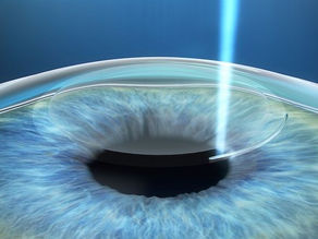 SMILE vs. LASIK: Which Laser Eye Treatment Is Best in 2026?