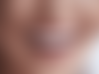 Are Prepless Veneers the Perfect Solution for Your Smile Makeover?