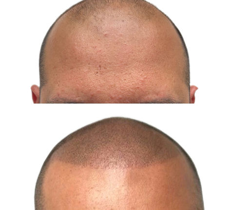 SMP Haarpigmentierung Haarverdichtung