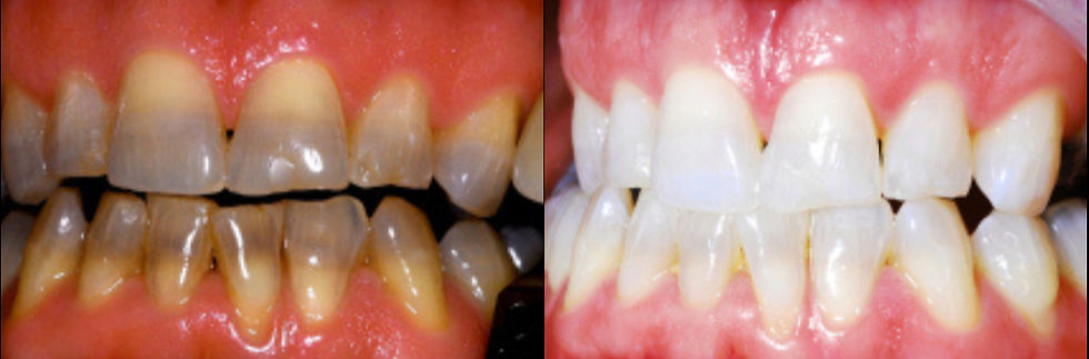 Unlock Your Brightest Smile with KöRWhitening: A Comprehensive Guide