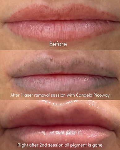 Best Lip blush laser removal near you, Candela PicoWay