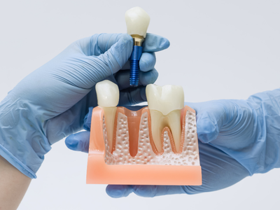 DENTAL IMPLANTS.png