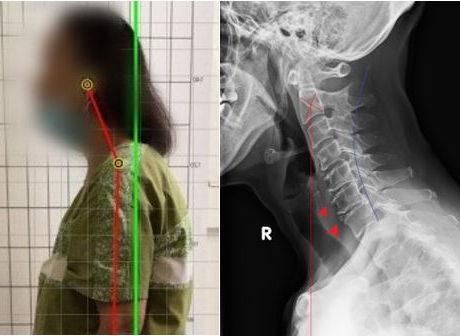 Is Your Brain Fog Caused By Your Spine? 