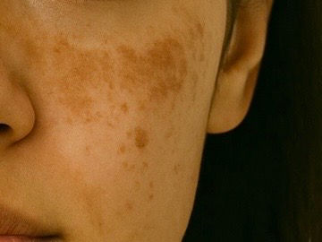 Melasma: 4 produtos para tratar e prevenir manchas