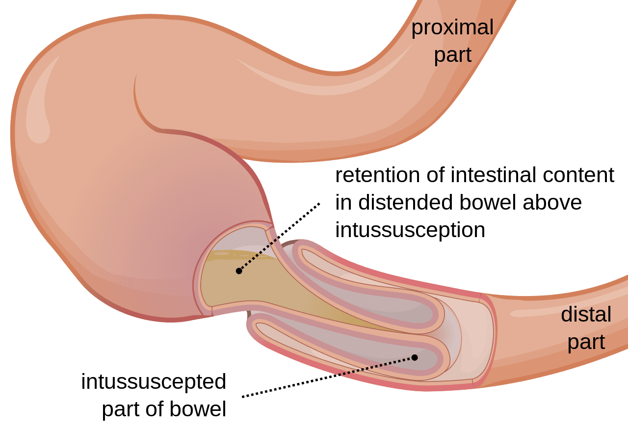 intussusception diagram of intestines inverting inside one another