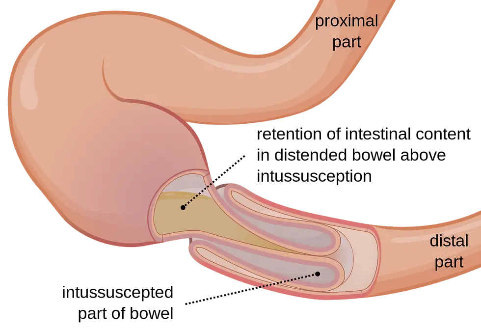 intussusception diagram of intestines inverting inside one another