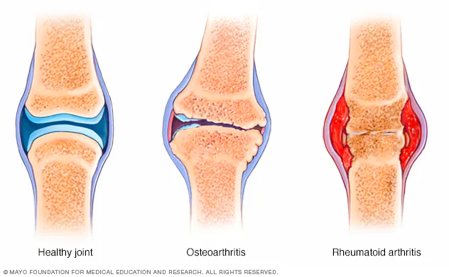 Diagram showing healthy joint vs osteoarthritis and rheumatoid arthritis joints