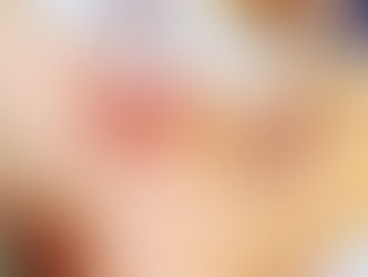 刺絡と骨折後遺症
/鍼灸院/鍼灸ゆーせん/大阪府八尾市上尾町