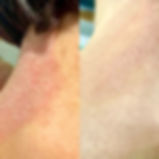 Image Soulagement de la psoriasis eczéma dermatite avec Derma Douce Plus 15% d'urée