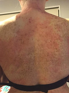 Eczema diet before