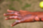 Burn Injury