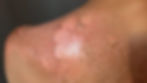 Acute SLE - Blistering Rash