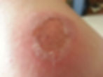 Burn Injury