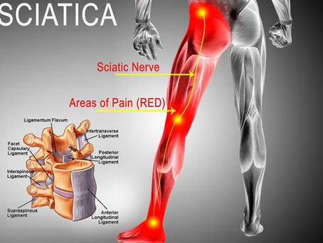 Natural Herbal Cure for Sciatica, Arthritis, and Waist Pain: A Comprehensive Guide