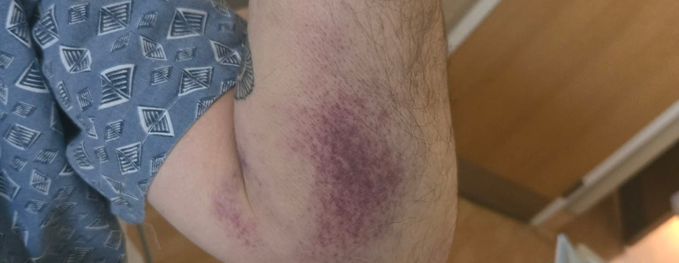 bruising and edema from stupid lab tech