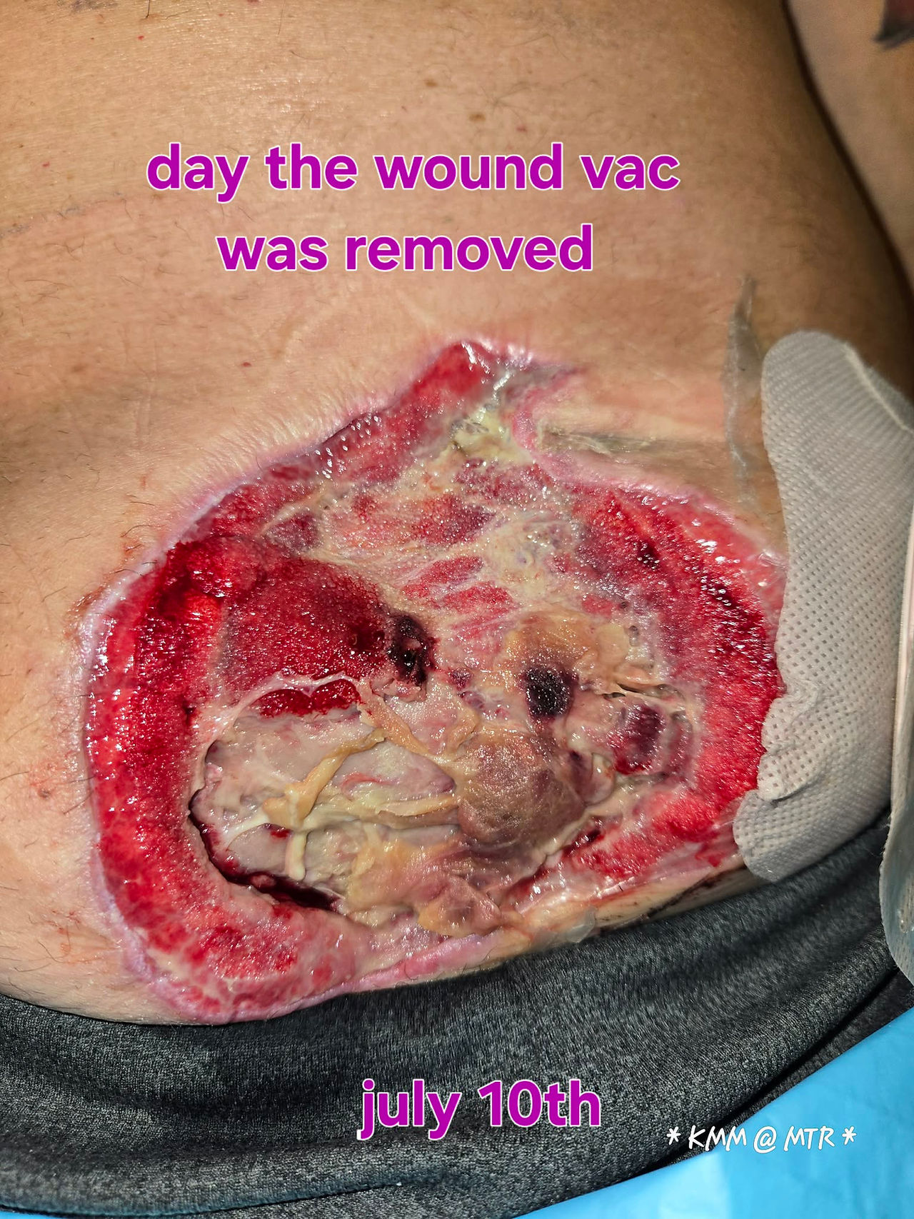 day after the Ileus - total separation and way too close to the Stoma