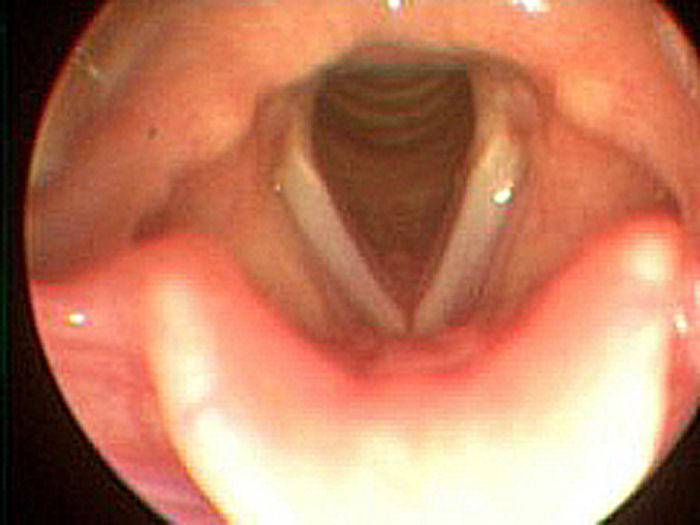 Voice Disorders