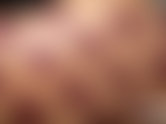 The Truth About Cupping Bruises: Are They Really Bruises?