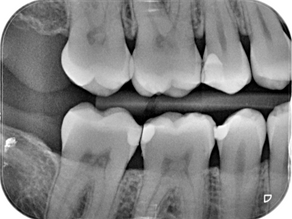 ¿Son seguras las radiografías dentales periapicales?