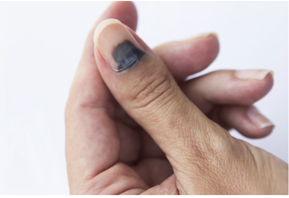 nail bed injury