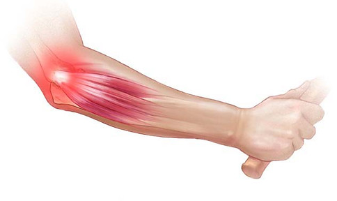 tennis-elbow-strain