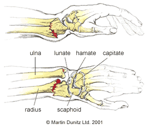 colles_fracture_bones