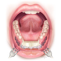 Intraoral view post-mandibulectomy with mandibular reconstruction plate and loss of lower lip support.