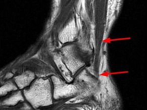 Ankle: Accessory Soleus Muscle