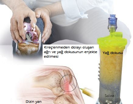 DİZ KİREÇLENMELERİNİN ve SPORTİF YARALANMALARININ TEDAVİSİNDE YENİ GELİŞMELER