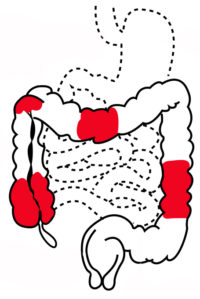 Darm Grafik - Morbus Crohn