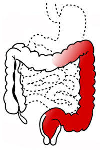 Darm Grafik - Colitis ulcerosa