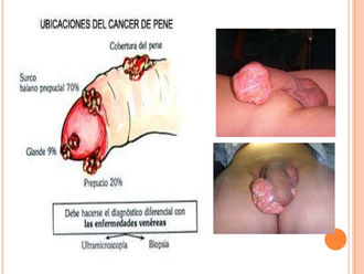 Cancer de pene