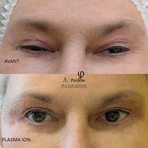 Plasma Pen Ion de la Phi Academy utilisé pour le raffermissement de la peau sans chirurgie