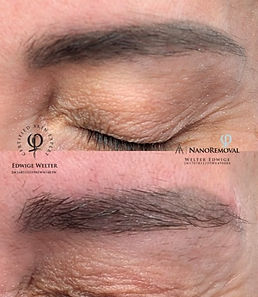 detatouage_nano_removal_juste_apres_ (1).jpg