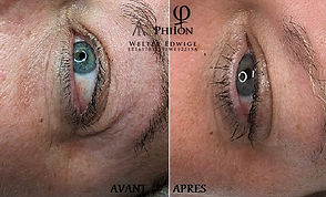 PLASMA PEN ET MICRONEEDLING blepharoplastie_des_paupieres_plasma_pen_affaissement_des_paupieres