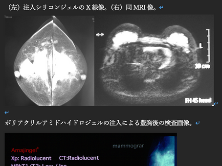 非吸収性フィラーの歴史と惨害――ウクライナ、中国から来た物質