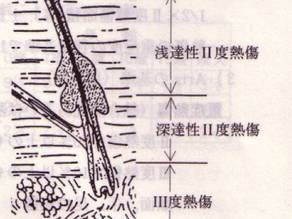 熱傷(やけど)と後遺症(瘢痕ケロイド、瘢痕拘縮)