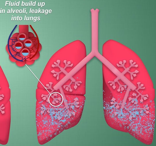 lungs.jpg