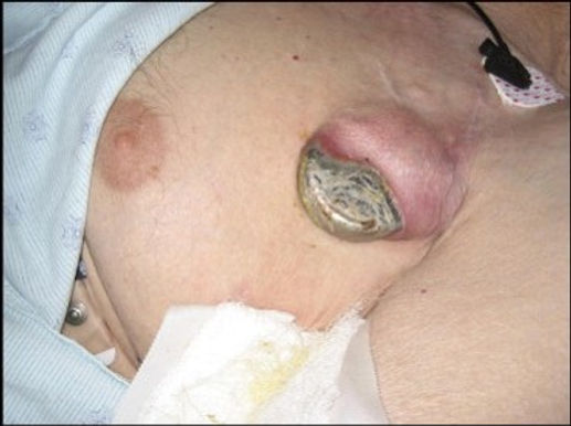 infect.jpg