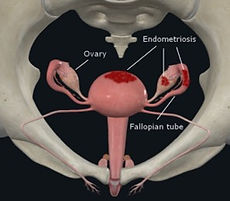 endo3.jpg