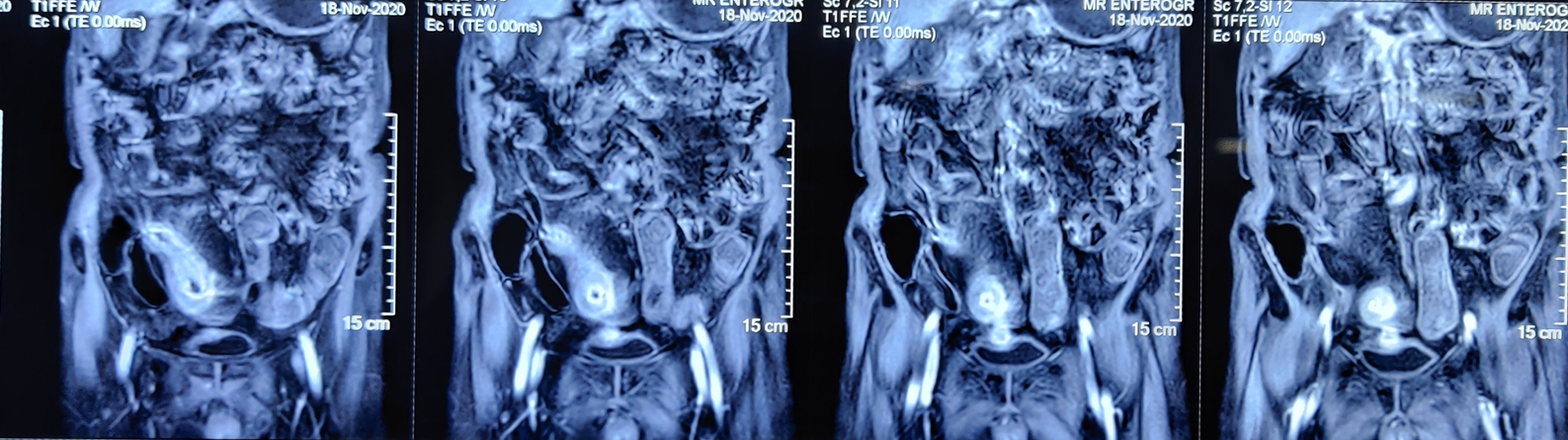 73 Yrs Male with Hypertension, Chronic obstructive pulmonary disease (COPD), Dilated cardiomyopathy (DCM) content media