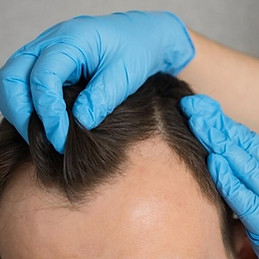 entradas-no-cabelo-1719441323.jpg
