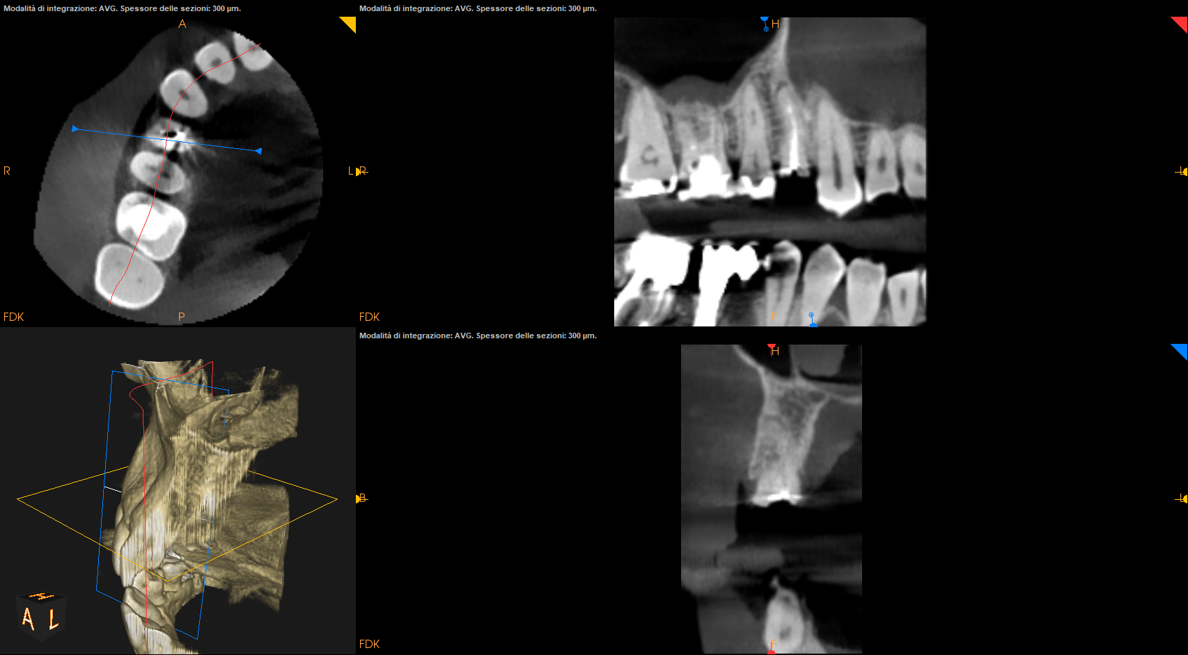 Post extractive implant ,easy and simple!! content media