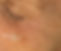 ipl-facial-D.jpg