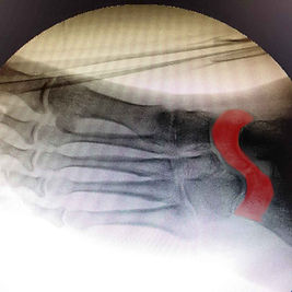 Coalizão Tarsal 