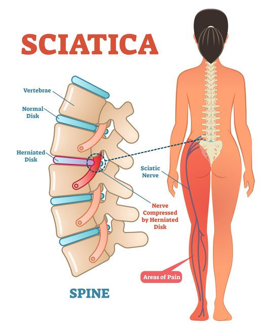 A diagram of the sciatic nerve being compressed by a herniated disc in the spine