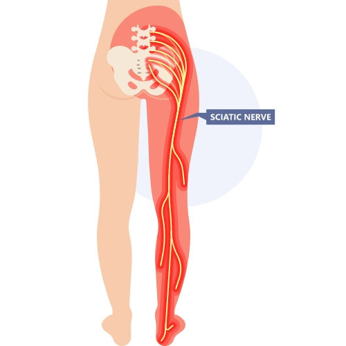 A diagram of the sciatic nerve travelling from the lower back down one leg