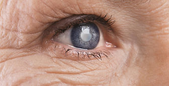Chirurgie cataracte à Lille